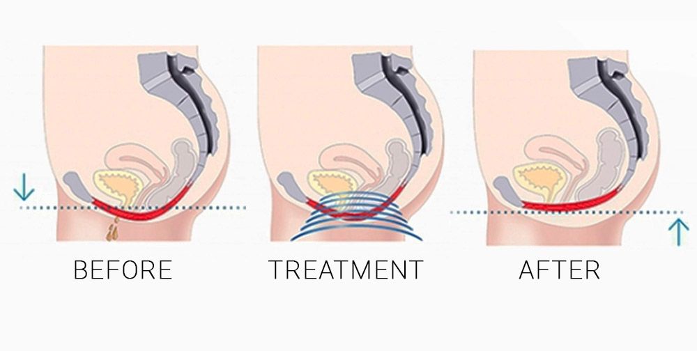 Pelvic floor before, during, and after Emsella treatment